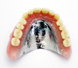 金属床(コバルトクロム)義歯