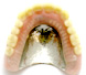 金属床(バイタリューム）義歯