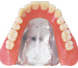金属床(チタン）義歯